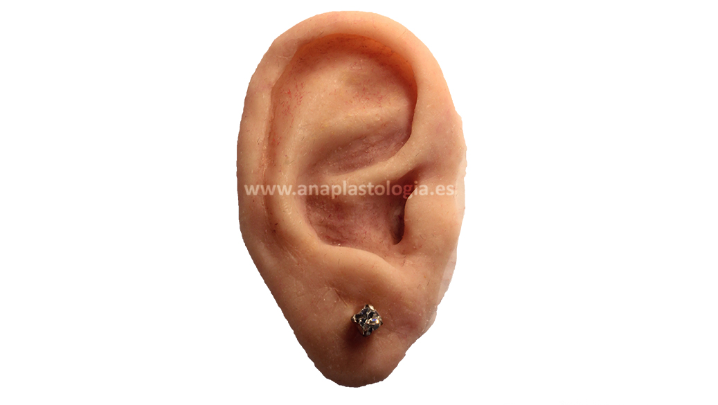 Prótesis de oreja de silicona fabricada a medida