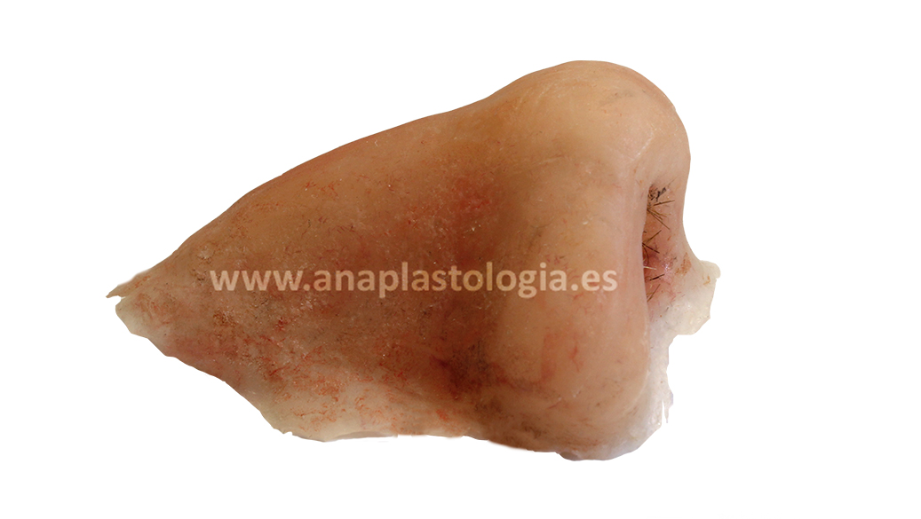 Prótesis nasal de silicona a medida, vista de perfil