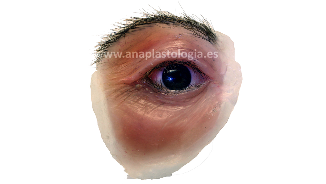 Prótesis orbitaria de silicona a medida con ojo y párpados