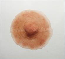 Prótesis de mama y areola a medida
