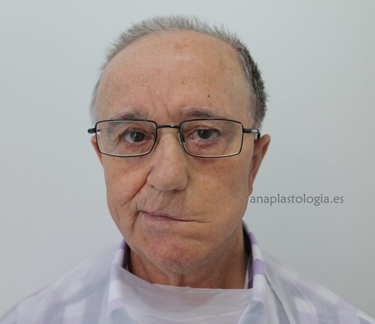 Paciente con prótesis auricular sobre implantes, vista frontal