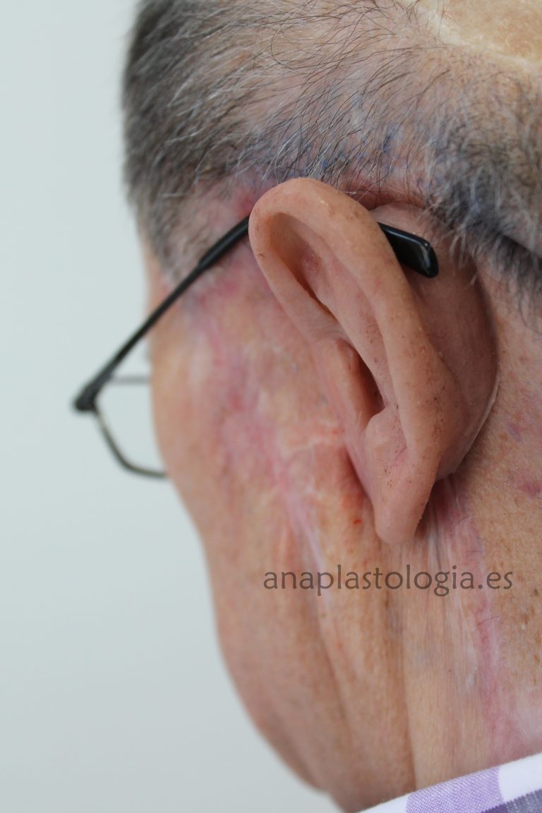 Prótesis auricular sobre implantes, vista posterior con gafas