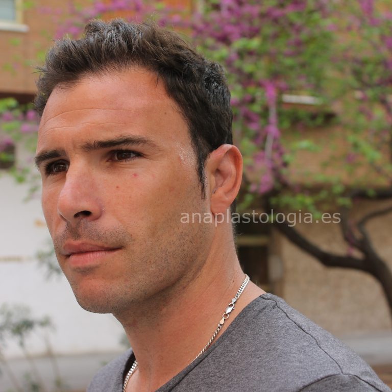 Hombre con prótesis auricular adhesiva a medida