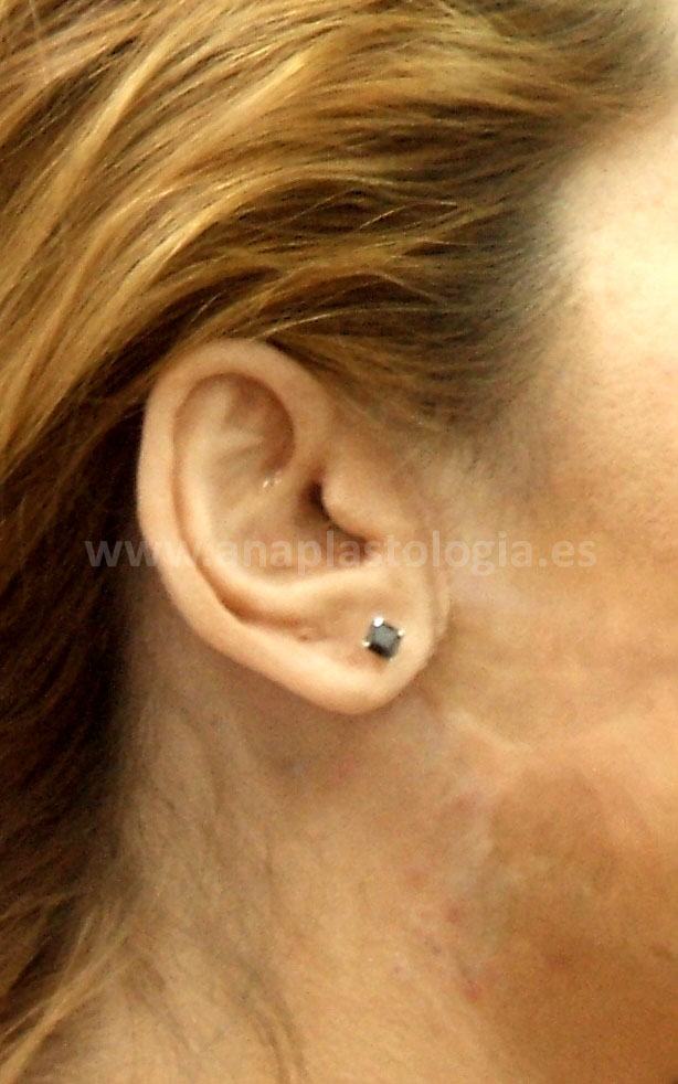 Prótesis de oreja sobre implantes en mujer, con pendiente