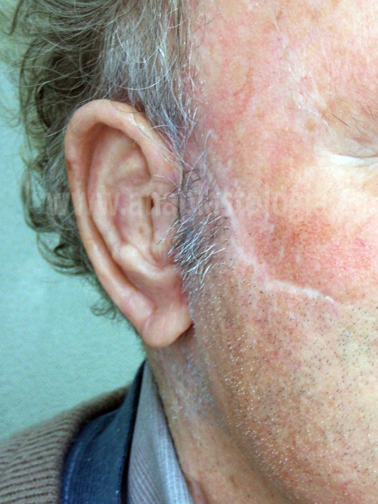 Detalle de prótesis auricular sobre implantes en paciente