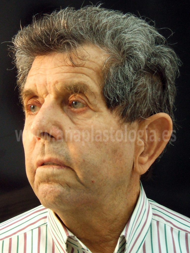 Paciente mayor con prótesis auricular sobre implantes