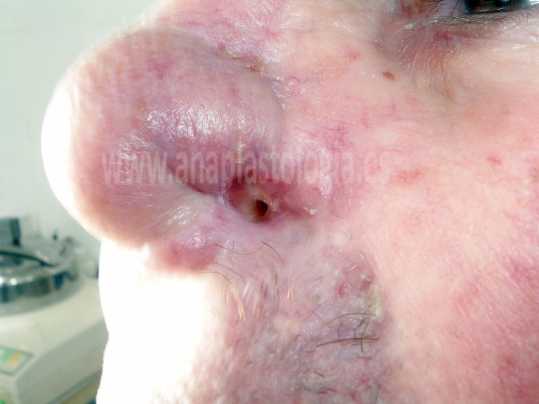 Conformador nasal a medida en Valencia