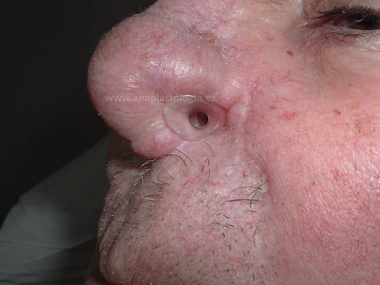 Conformador nasal a medida colocado en la fosa nasal de un paciente