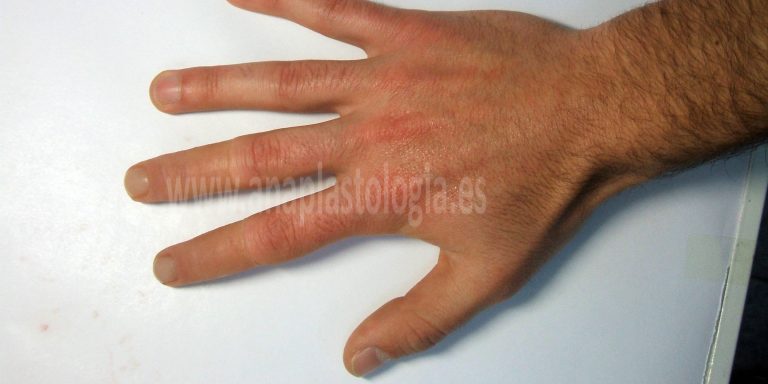 Prótesis de mano en hombre, vista dorsal