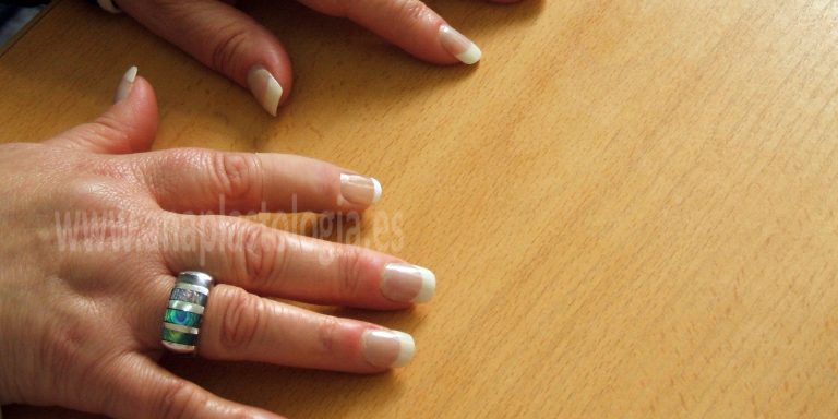 Manos sobre una mesa con prótesis de dedo y anillo