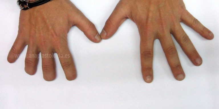 Comparativa de manos de hombre con prótesis de dedos