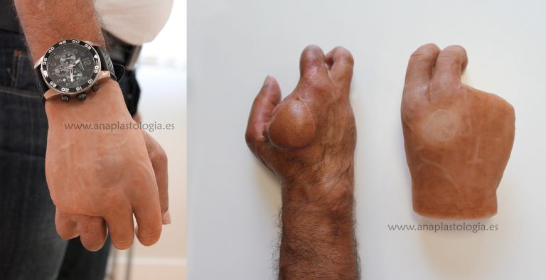 Prótesis parcial de mano: muñón y pieza de silicona
