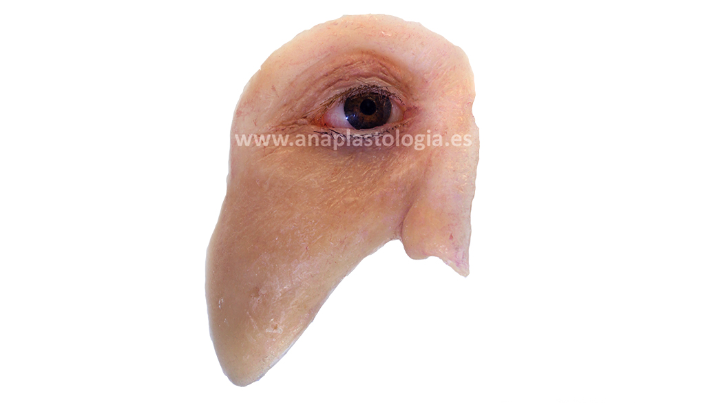 Prótesis hemifacial a medida en Valencia
