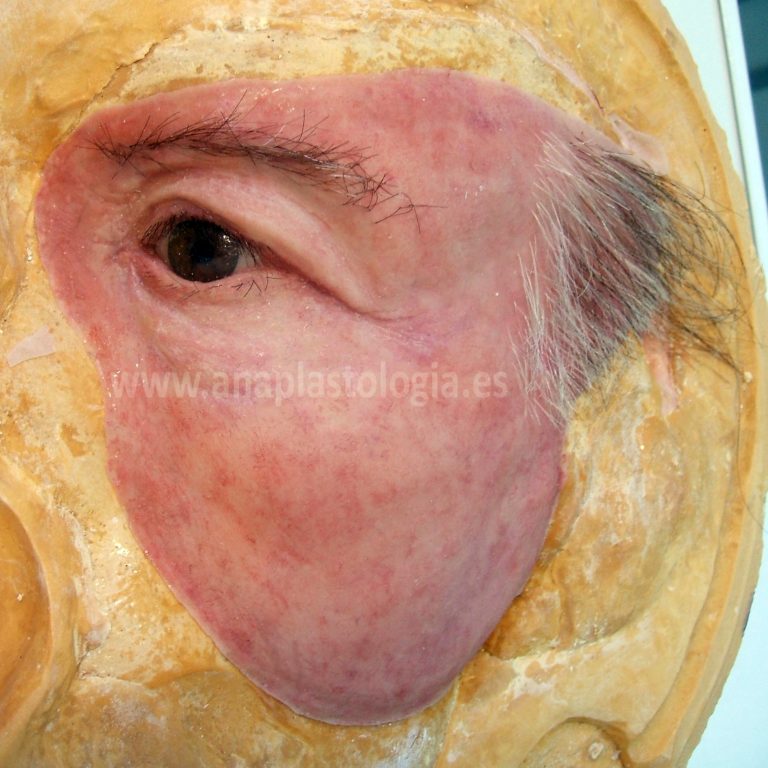 Prótesis hemifacial con órbita sobre el molde
