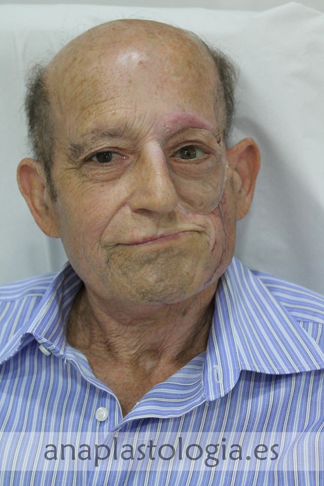 Hombre con prótesis hemifacial, vista frontal