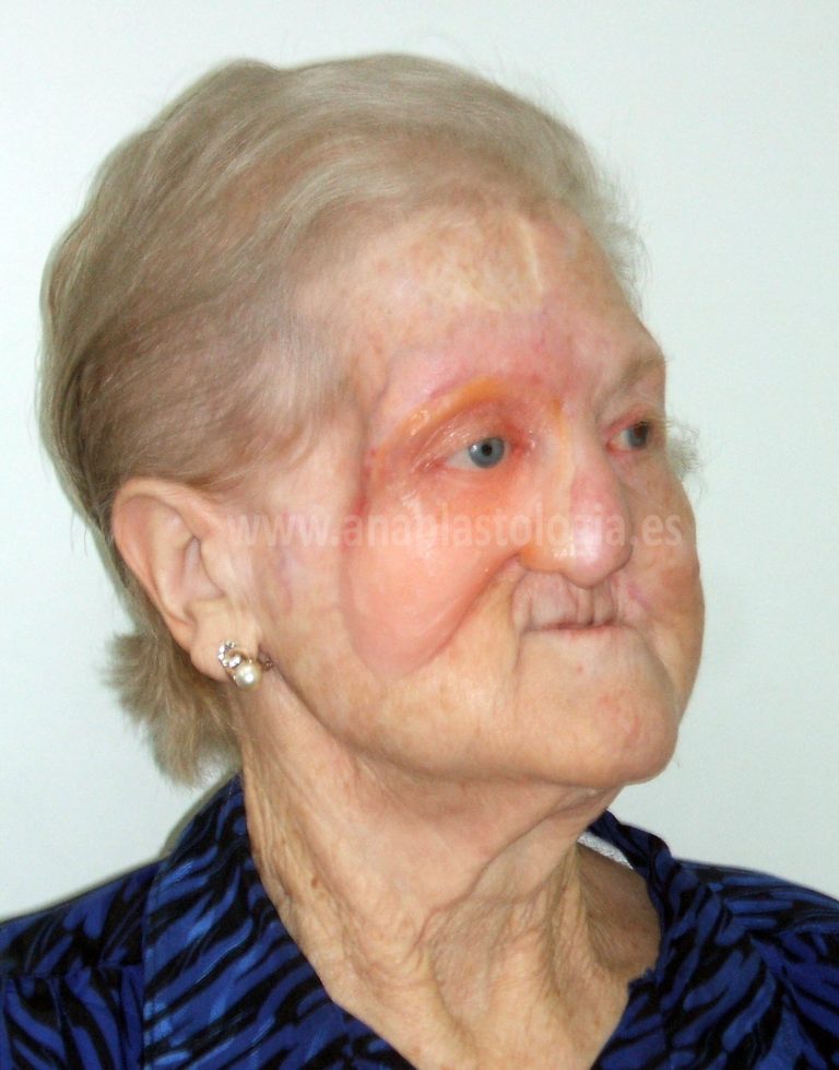Mujer mayor con prótesis hemifacial a medida