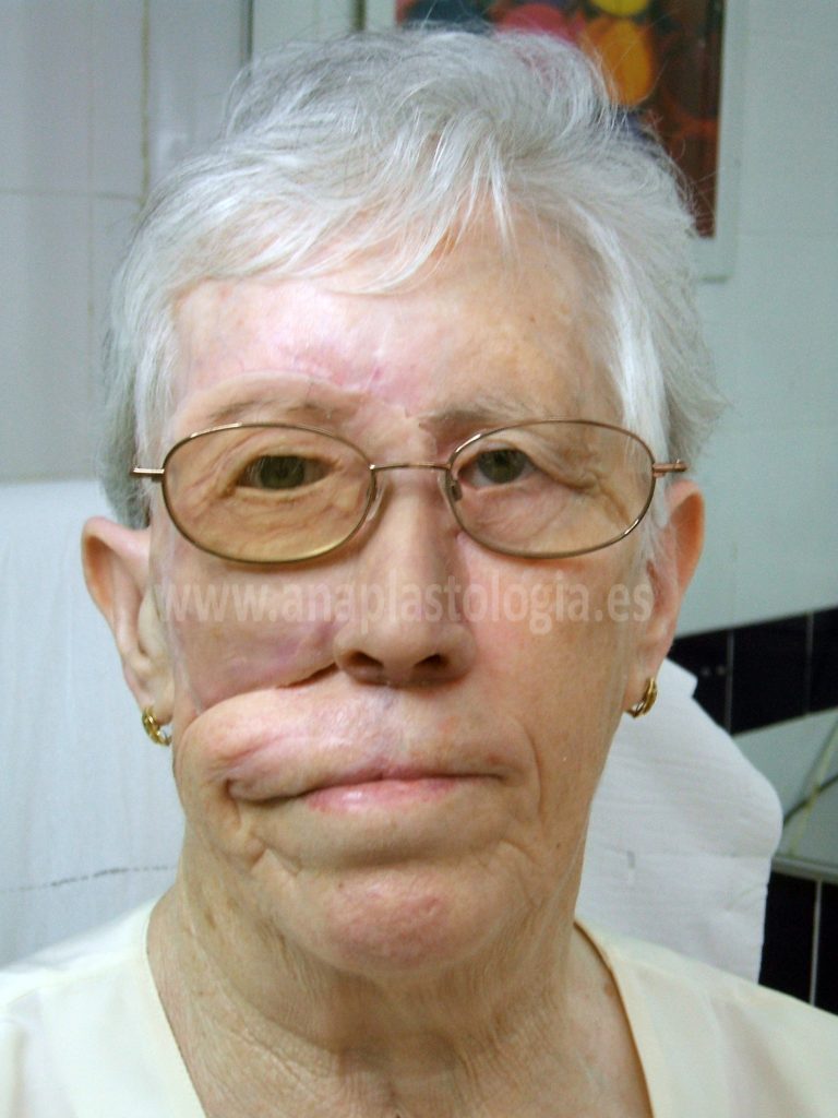 Paciente con gafas y prótesis hemifacial, vista frontal