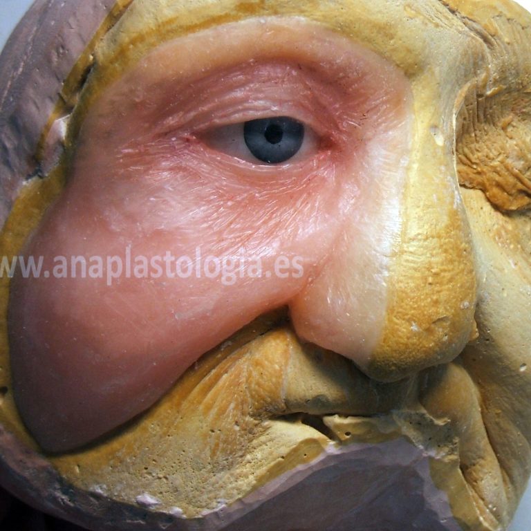Detalle de prótesis hemifacial sobre el molde de trabajo