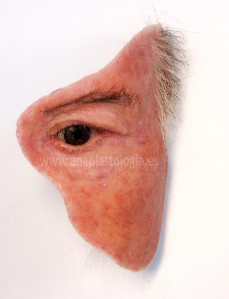 Prótesis hemifacial de silicona de órbita y mejilla