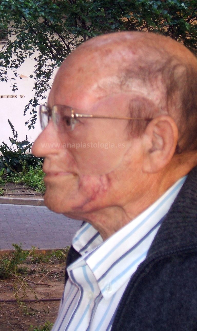 Paciente con prótesis hemifacial, vista de perfil