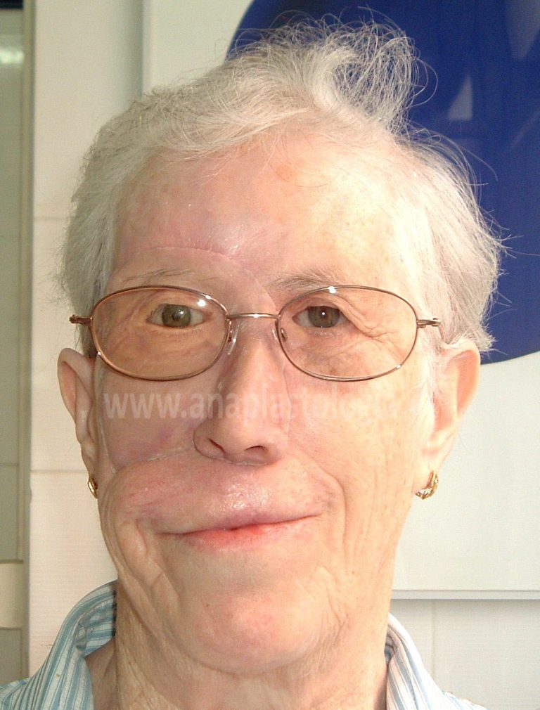Mujer con gafas y prótesis hemifacial a medida
