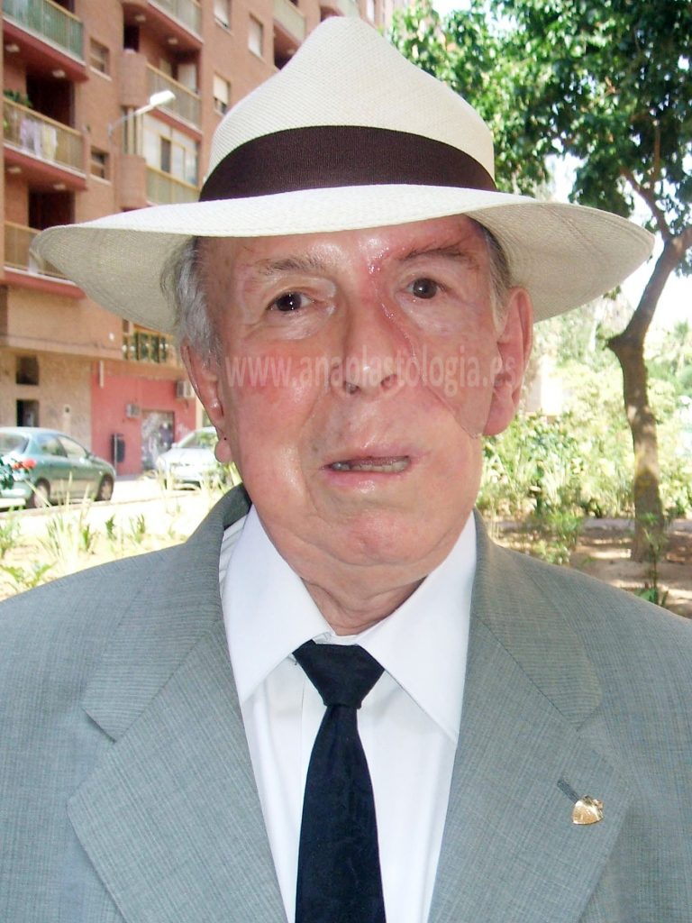 Paciente con sombrero y prótesis hemifacial a medida
