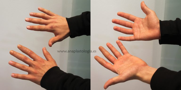 Prótesis de mano: comparativa de palma y dorso