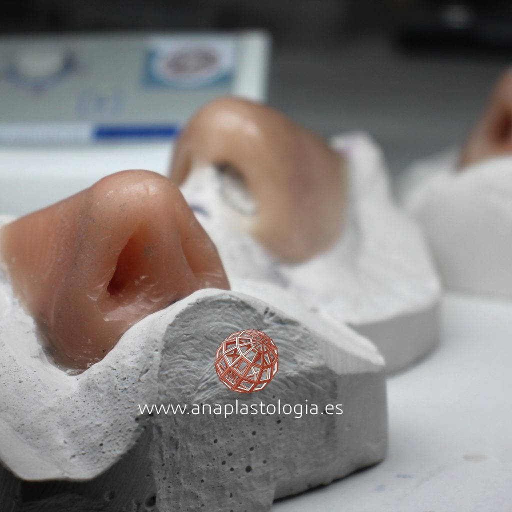 Prótesis nasal de silicona sobre el molde de escayola