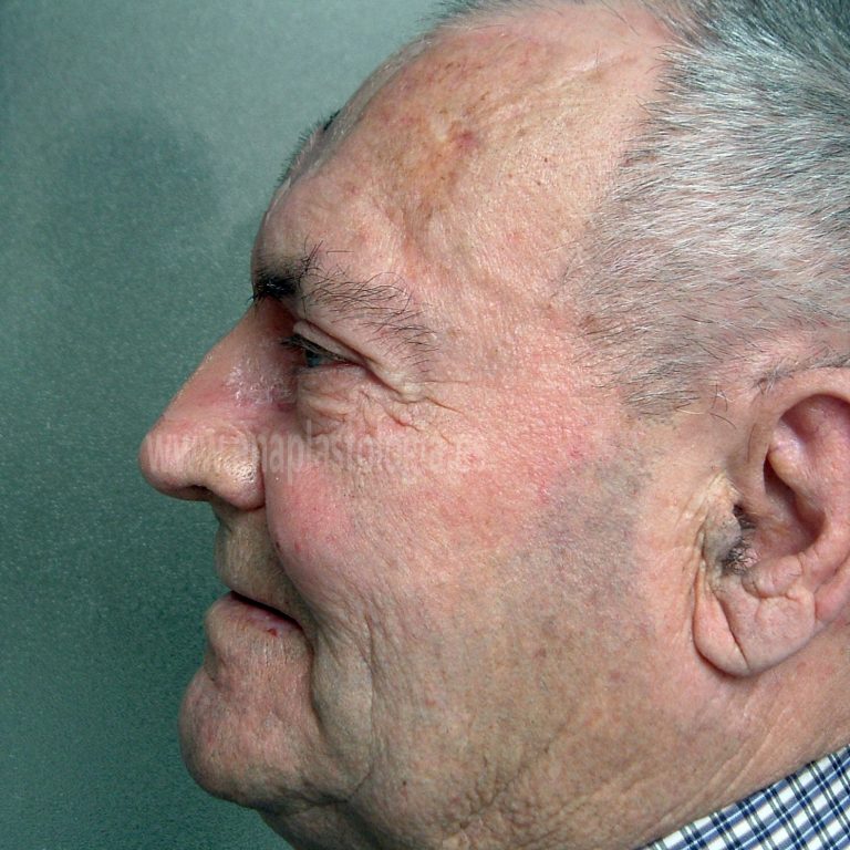 Paciente con prótesis nasal a medida, vista de perfil