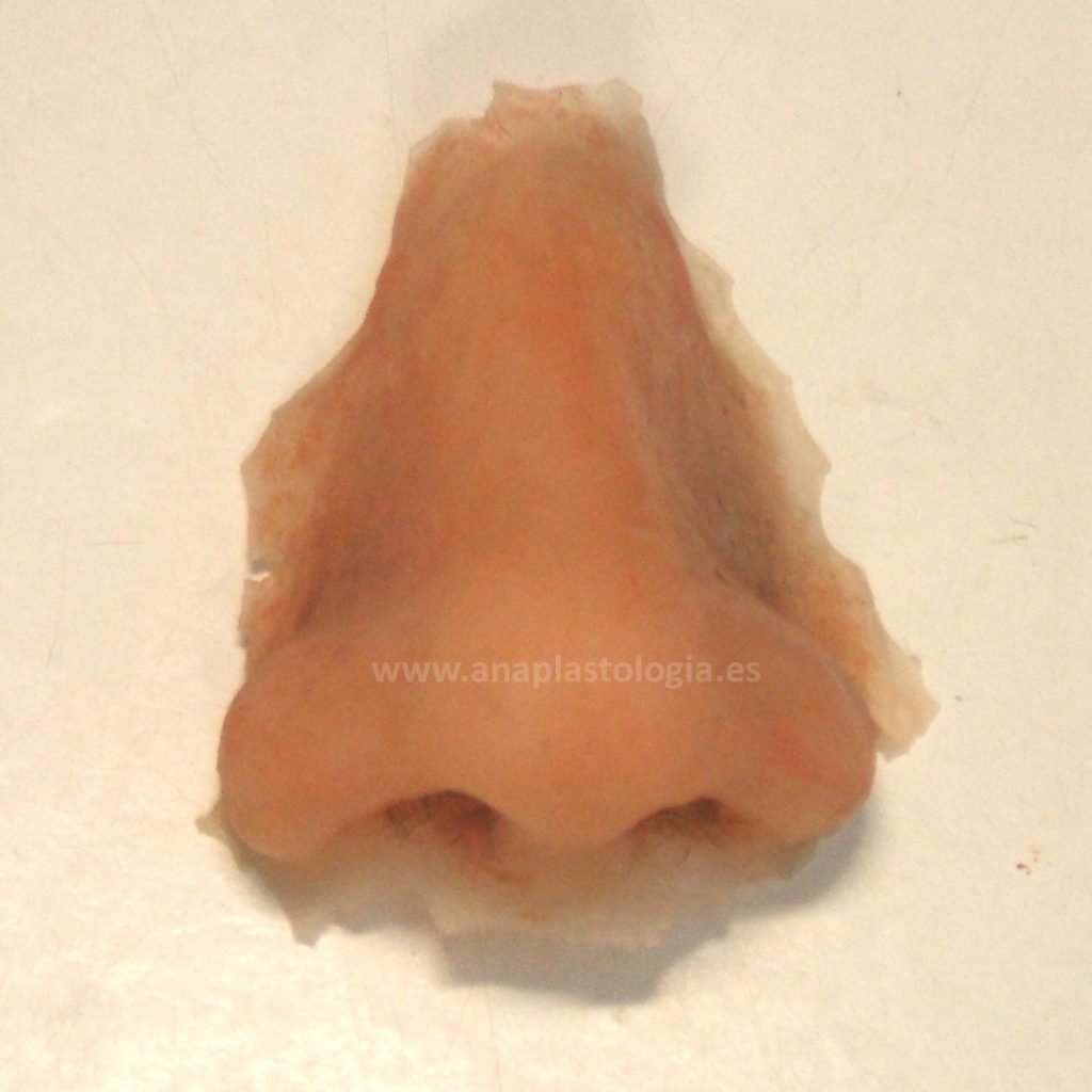Prótesis nasal de silicona, vista frontal