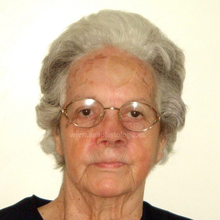 Mujer con gafas y prótesis nasal a medida