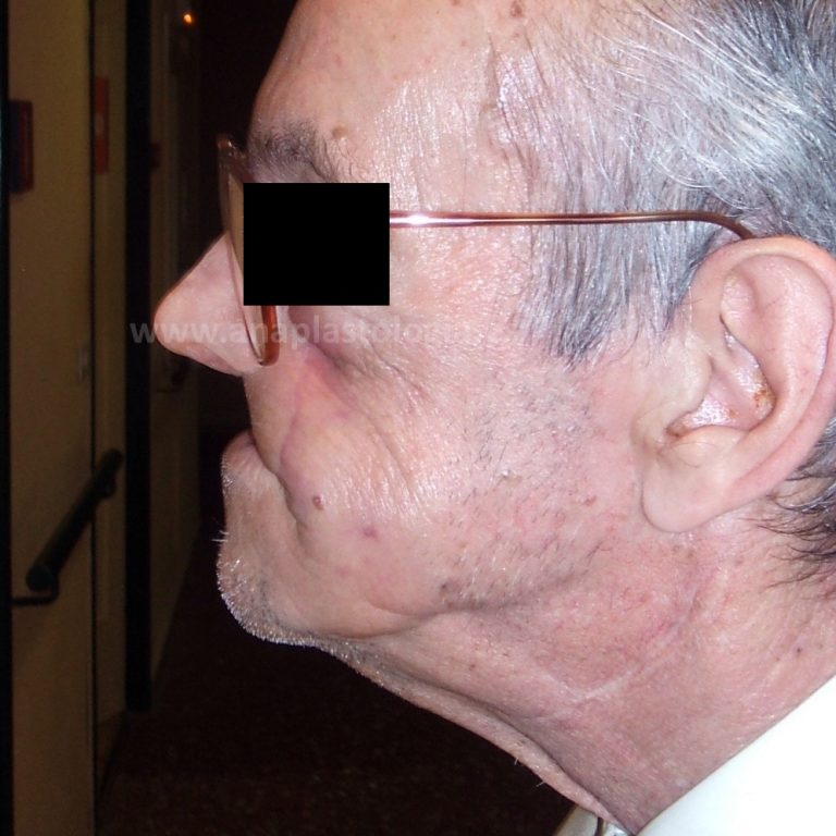 Paciente mayor con prótesis nasal, vista de perfil