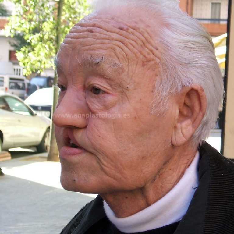 Paciente con prótesis nasal a medida en exterior