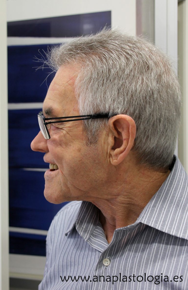 Paciente con gafas y prótesis nasal, vista de perfil
