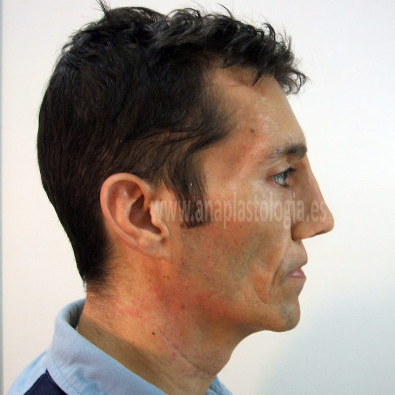 Hombre con prótesis nasal a medida, vista de perfil