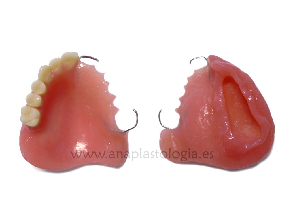 Prótesis obturadora palatina a medida con dientes
