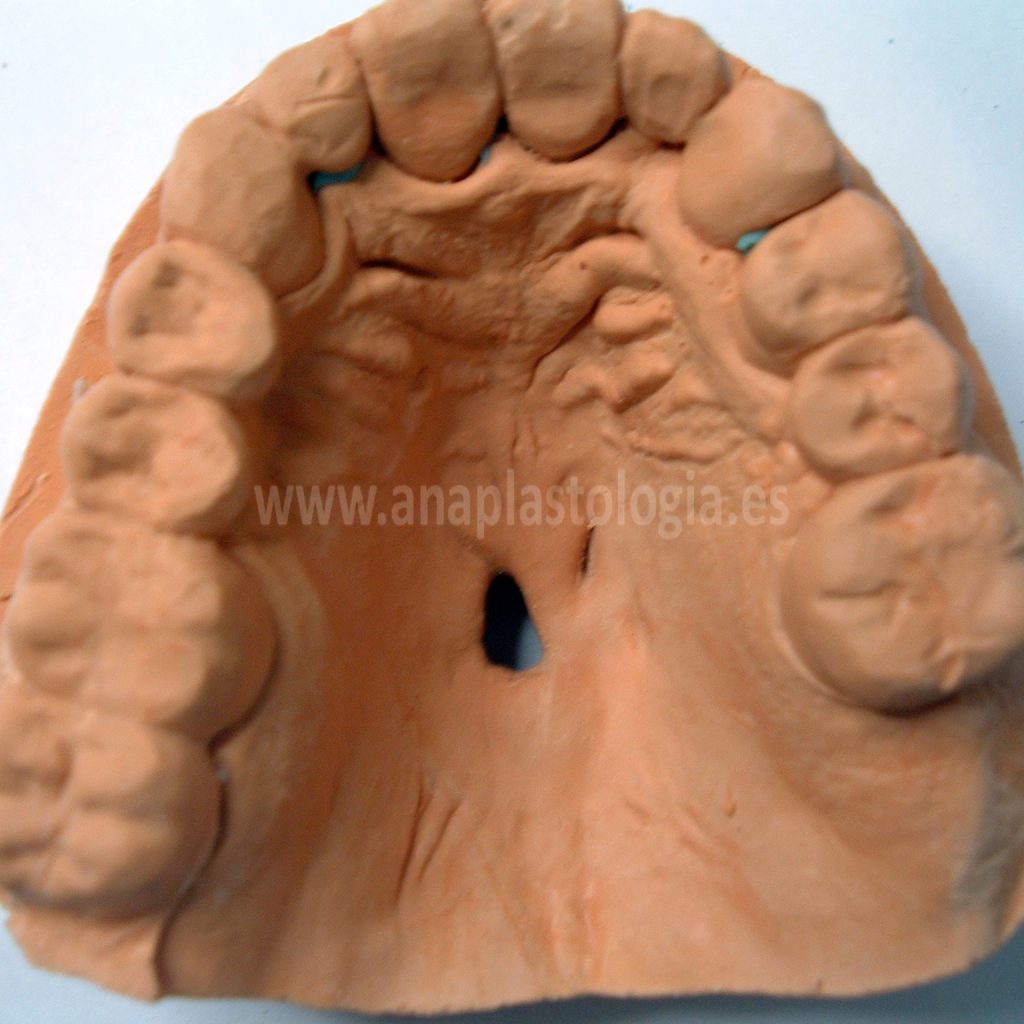 Modelo de escayola del paladar con defecto palatino