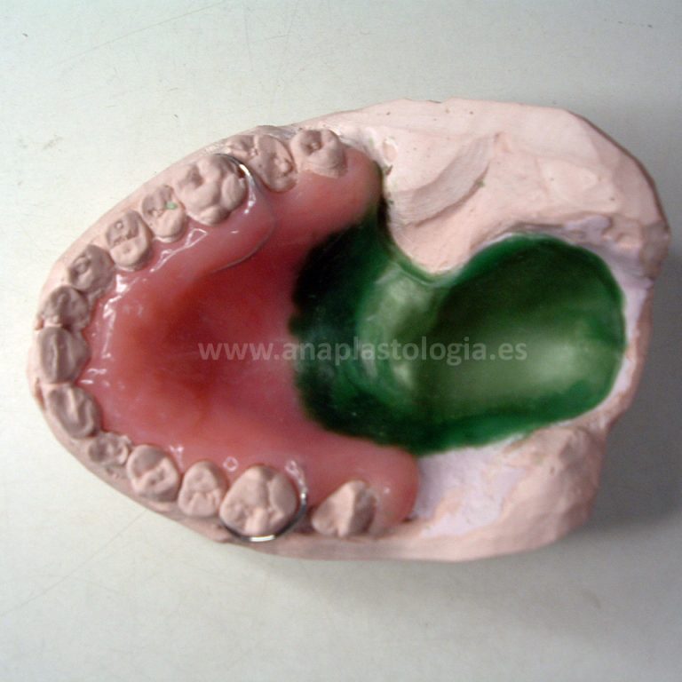 Molde de fabricación de un obturador palatino