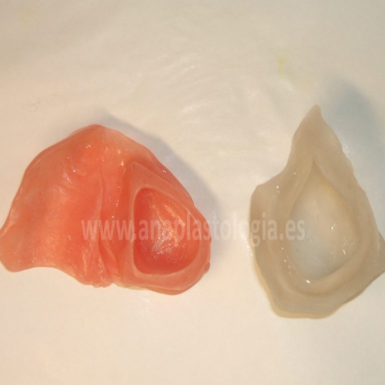 Piezas de un obturador palatino a medida