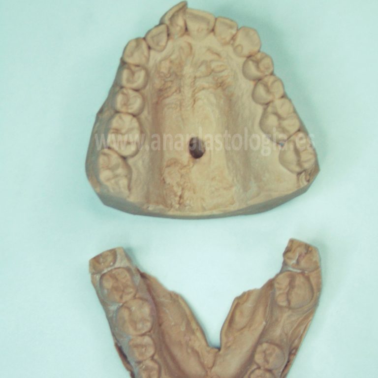 Modelos de escayola con defecto palatino