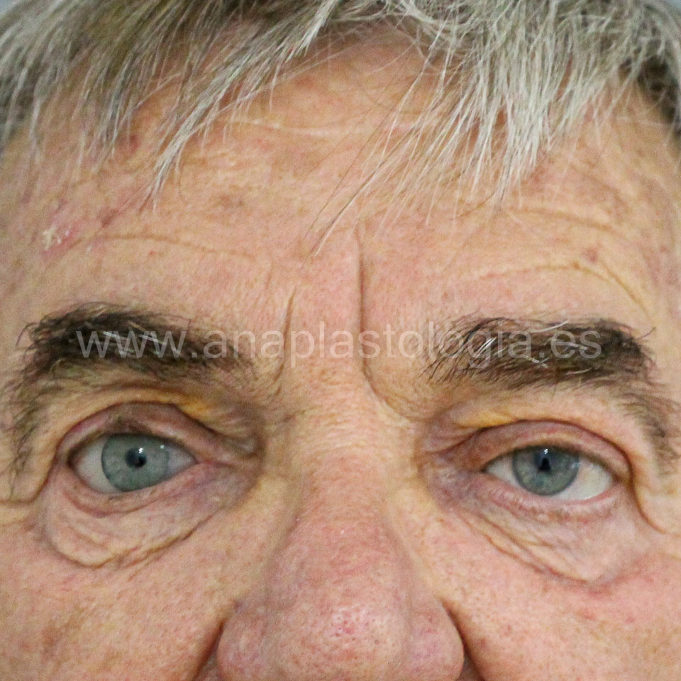 Prótesis ocular a medida en Valencia