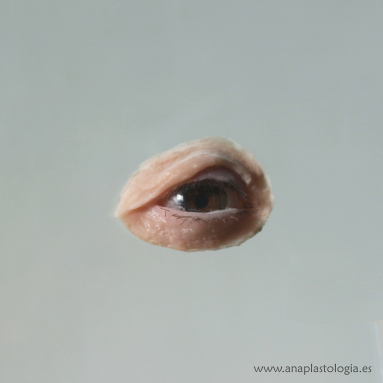 Prótesis oculopalpebral de silicona a medida