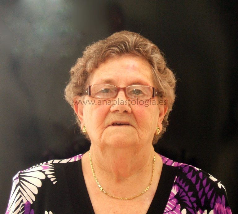 Mujer con prótesis orbitaria a medida, vista frontal