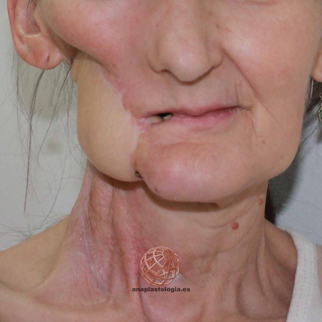 Prótesis parche facial en mejilla y cuello