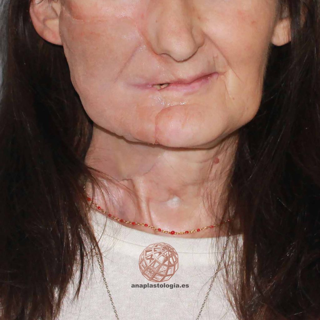 Resultado de prótesis parche facial, vista frontal