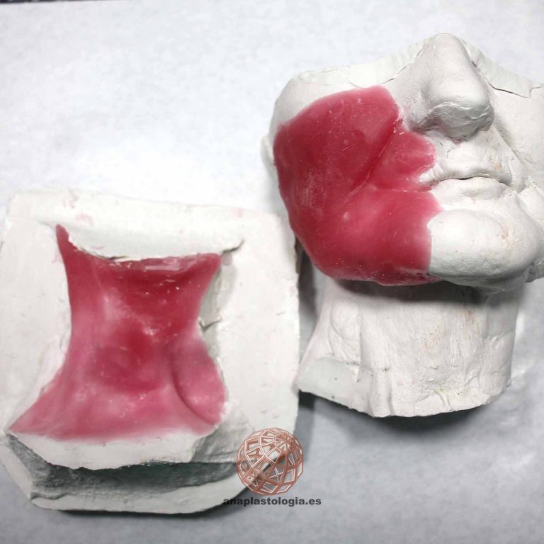 Moldes de cara y cuello para prótesis parche