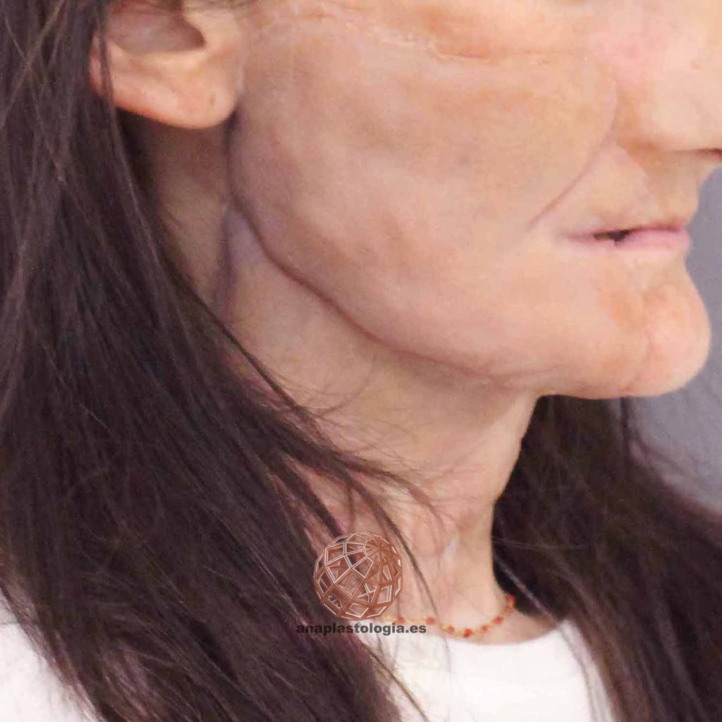Resultado de prótesis parche facial, vista de perfil