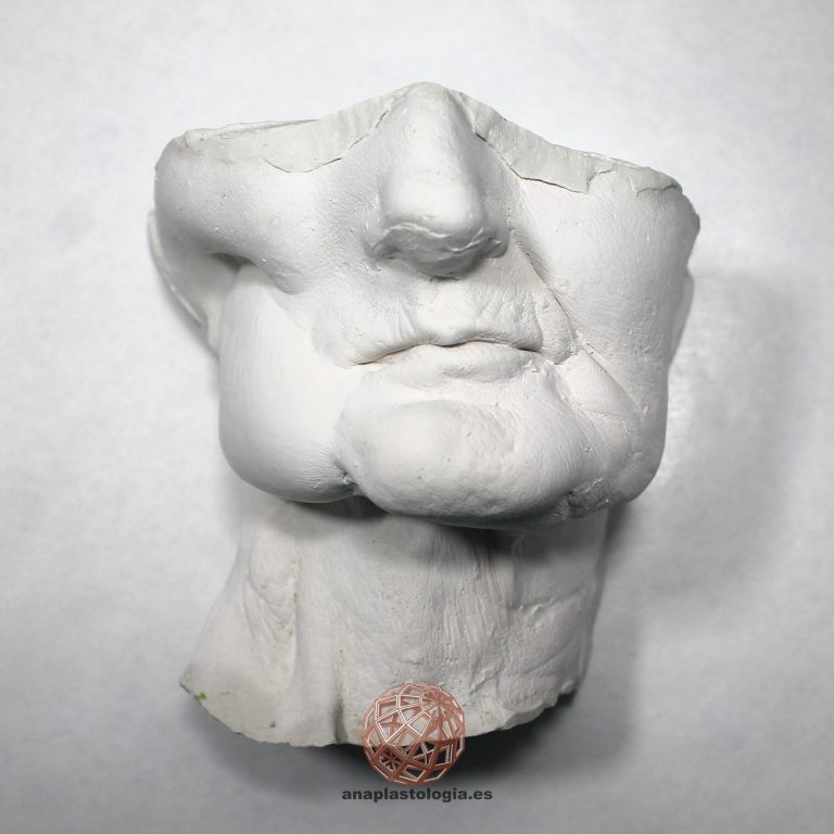 Molde de escayola del rostro de la paciente