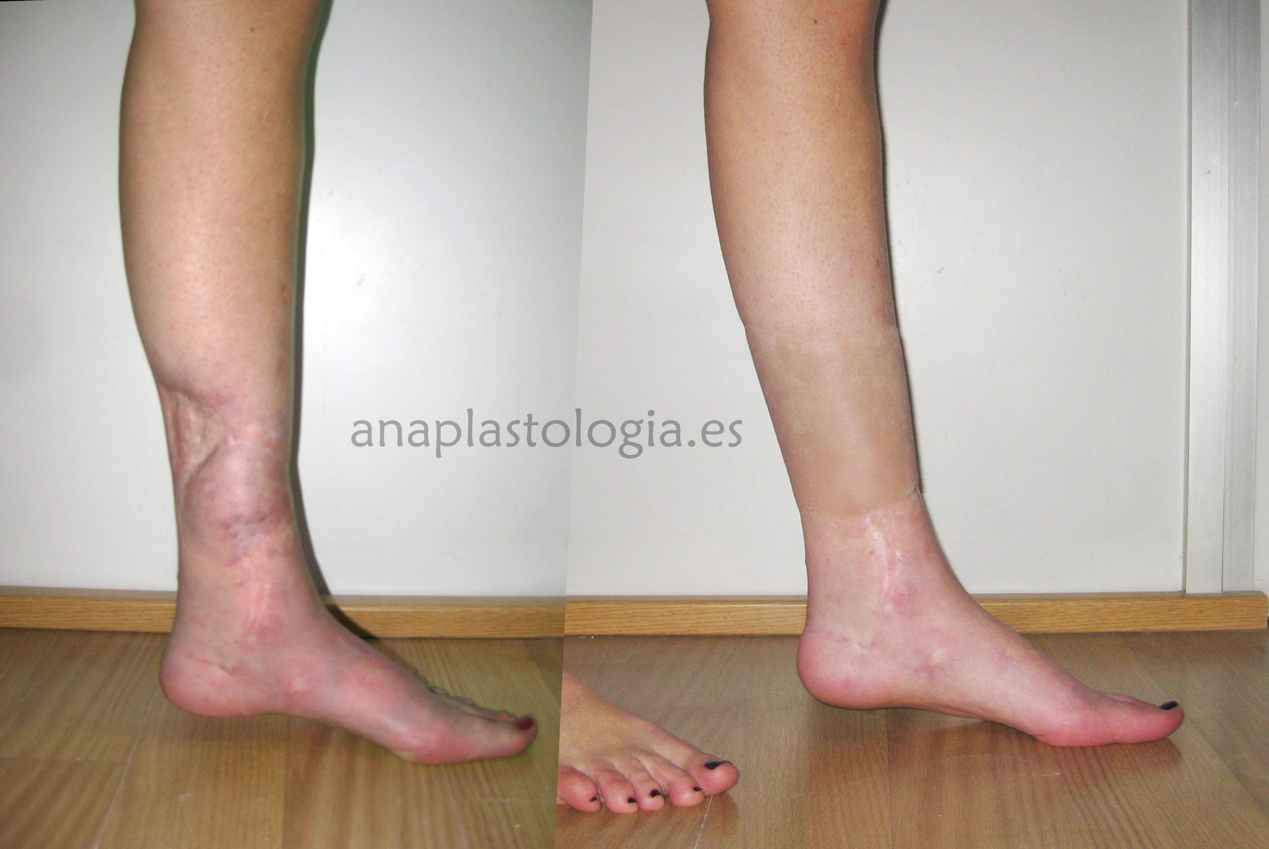 Epítesis de recubrimiento en silicona médica