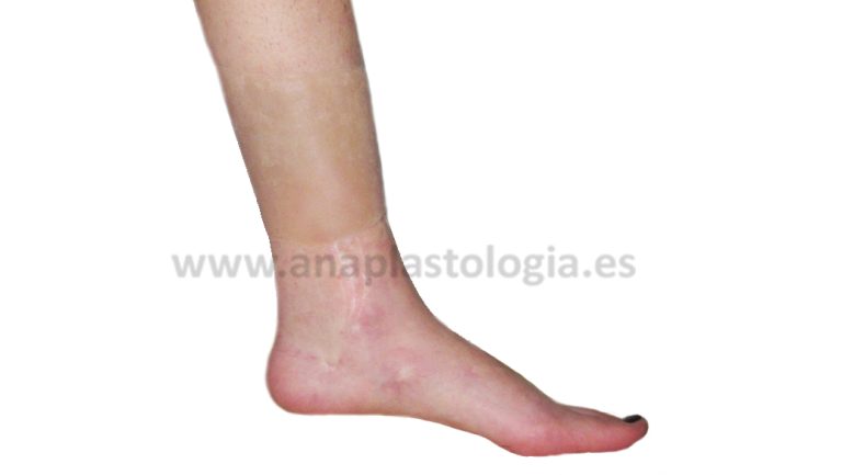Epítesis de recubrimiento en silicona médica